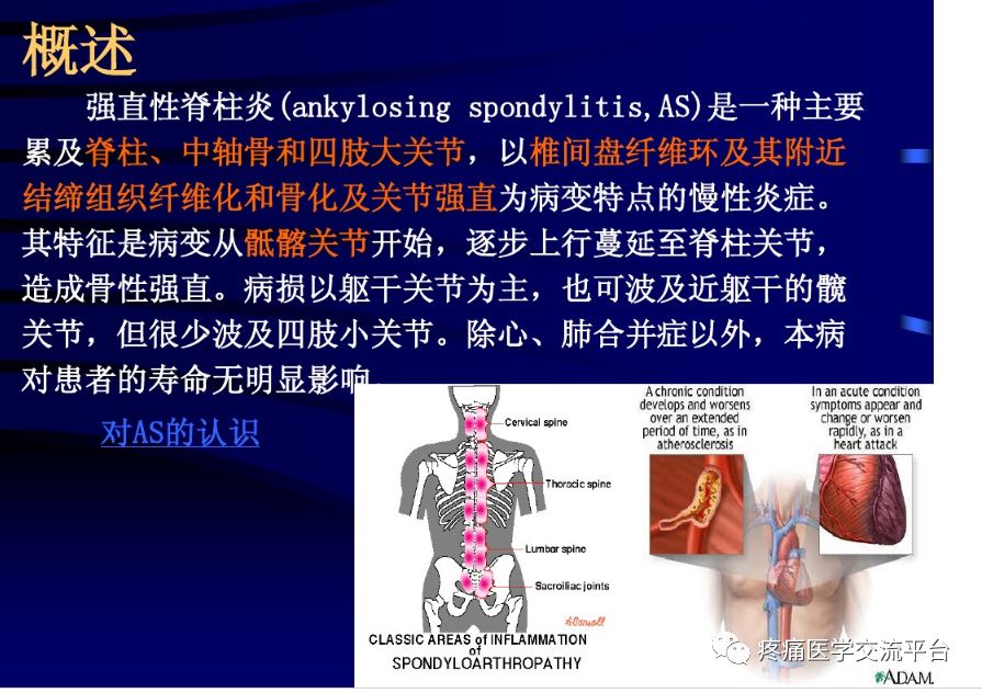 強(qiáng)直性脊柱炎最新療法,強(qiáng)直性脊柱炎最新療法，突破傳統(tǒng)，走向新生