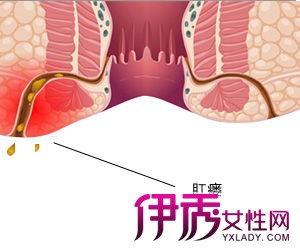 肛瘺的最新治療方法,肛瘺的最新治療方法