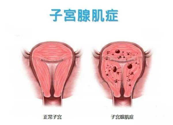 子宮腺肌癥最新治療,子宮腺肌癥最新治療進(jìn)展與策略